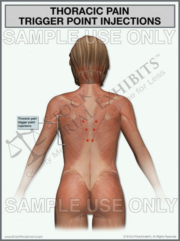 Thoracic Pain Trigger Point Injections Exhibit (Female)