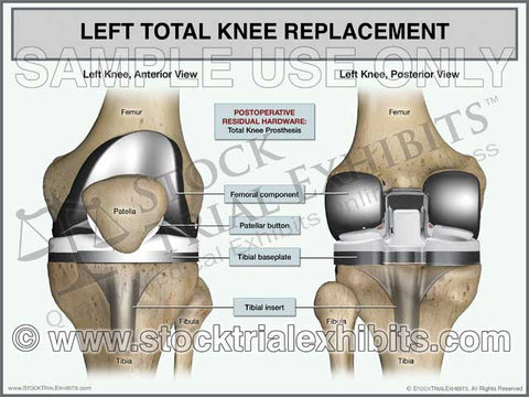 Total Knee Replacement Left Knee (2 Views)
