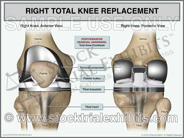 This stock trial exhibit shows the anatomy and postoperative residual hardware for a total knee replacement surgery performed on the right knee. This exhibit graphically depicts the right knee with total knee prosthesis in the anterior and posterior views, with descriptive labels of the hardware components of total knee prosthesis and anatomy of the knee.