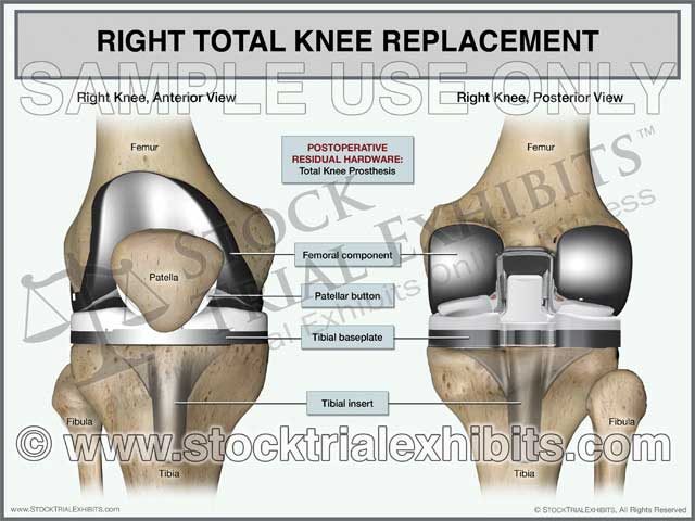 Right Rear Knee Assembly Total Knee Replacement Right Knee (2 Views) – Stock Trial Exhibits