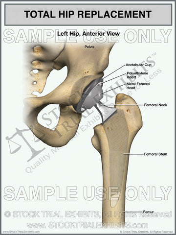 Total Hip Replacement of the Left Hip
