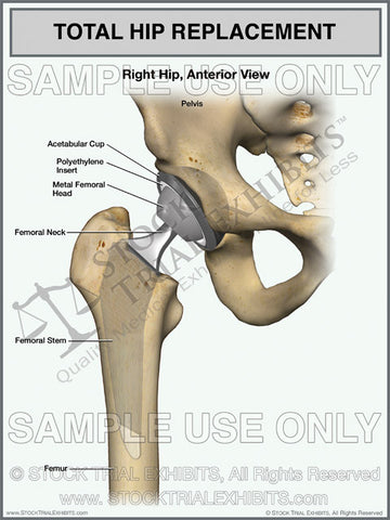 Total Hip Replacement of the Right Hip