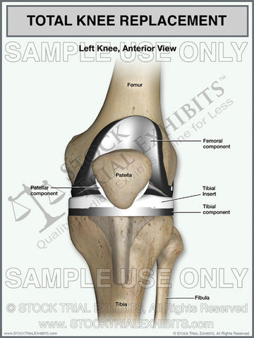 Total Knee Replacement of the Left Knee