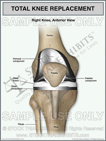 Total Knee Replacement of the Right Knee