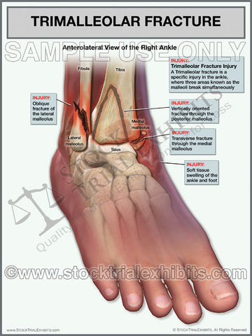 Trimalleolar Fracture of Right Ankle