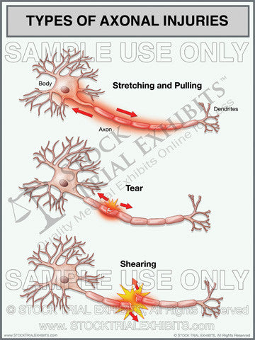 Types of Axonal Injuries stock medical illustration