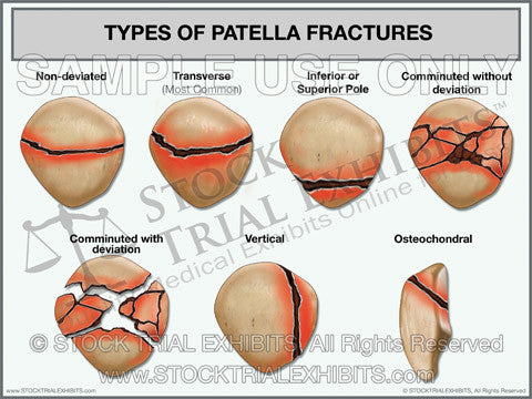 Types of Patella Fractures Trial Exhibit