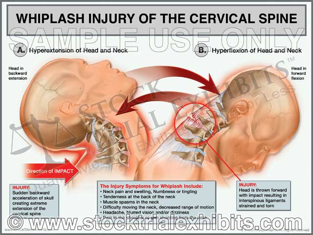This trial exhibit depicts Whiplash Injury of the Cervical Spine. It shows the mechanism of action of whiplash injury of the cervical spine, which is caused by hyper-extension of head and neck, and then hyper-flexion of head and neck. This injury typically may occur in auto accidents, falls and assaults. The exhibit also includes descriptive labels of injury symptoms of whiplash.