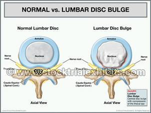 Normal_Lumbar_Disc_vs_Lumbar_disc_bulge